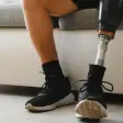 Amputation