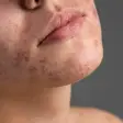Tuberous Sclerosis